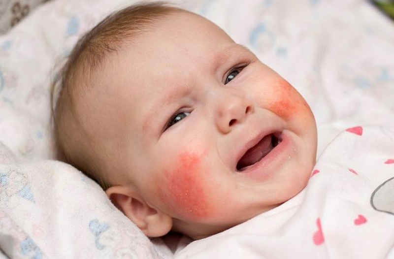 Cập nhập danh sách thuốc bôi dị ứng da mặt cho bé tốt nhất 1