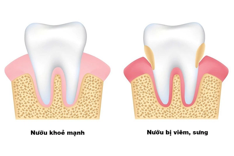 Bé mọc răng dưới lợi và một số biến chứng khác khi mọc răng sữa