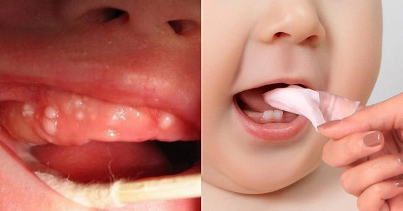 Bé sưng lợi bao lâu thì mọc răng? Dấu hiệu và cách chăm sóc hiệu quả