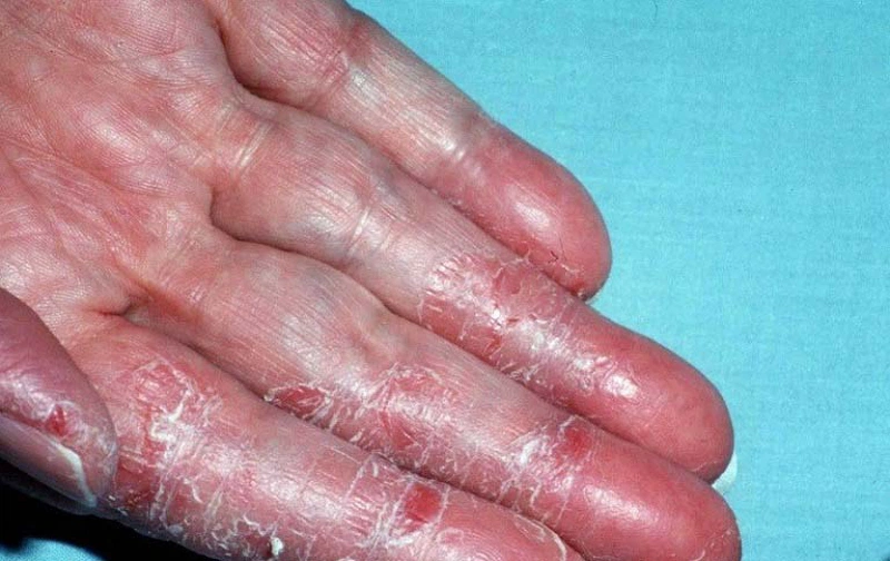 Bệnh á sừng ở tay: Mẹo chữa trị hiệu quả bằng phương pháp dân gian 1