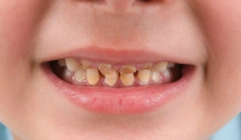 Nguyên nhân gây bệnh ăn mòn chân răng ở trẻ em