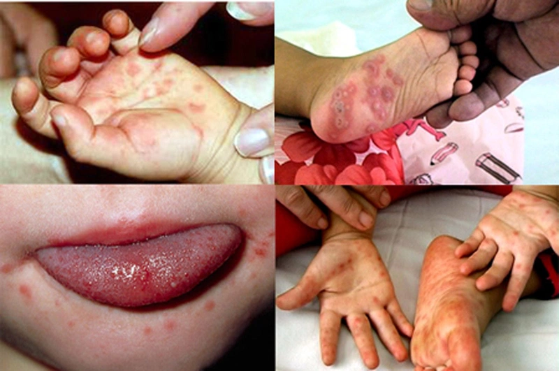 Bệnh tay chân miệng ở trẻ sơ sinh – Dấu hiệu và cách xử lý ...