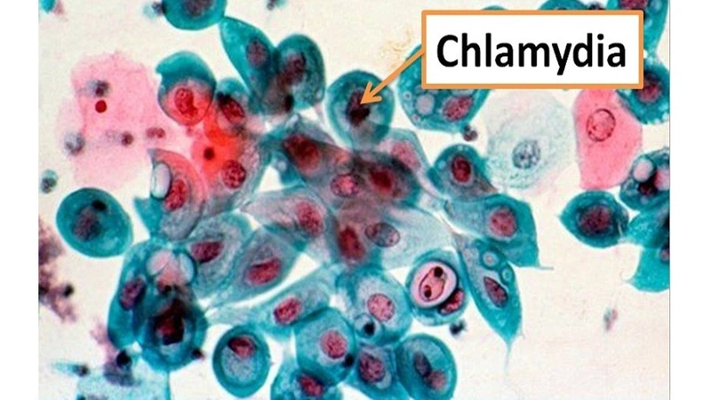 Bệnh Chlamydia có chữa khỏi được không? 1