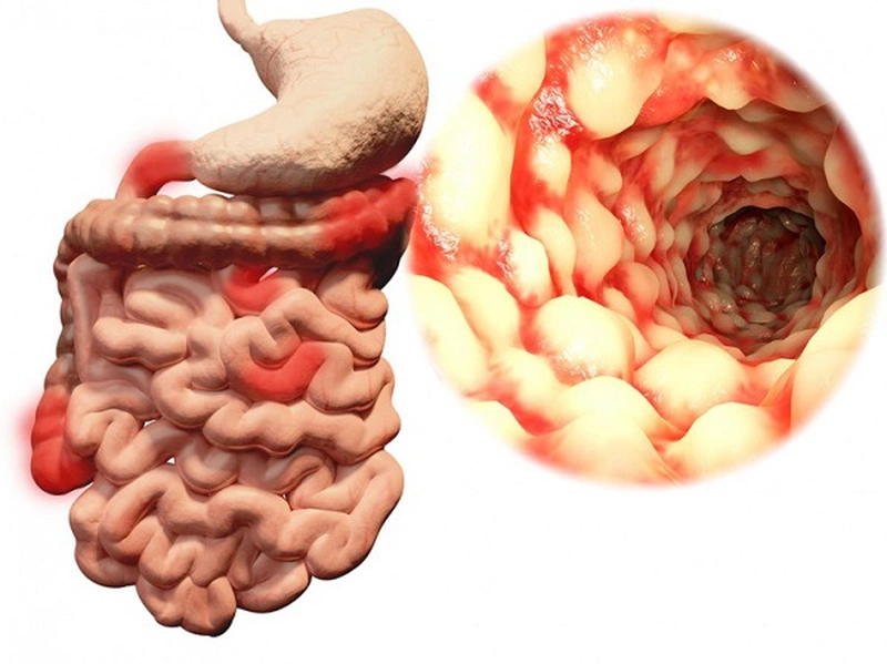 Bệnh Crohn của đại tràng là một bệnh mãn tính nên không thể chữa khỏi hoàn toàn
