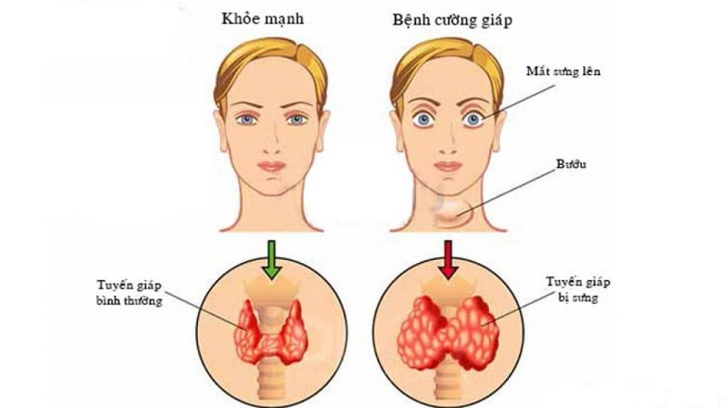 Bệnh cường giáp điều trị bao lâu và phương hướng điều trị như thế nào?4