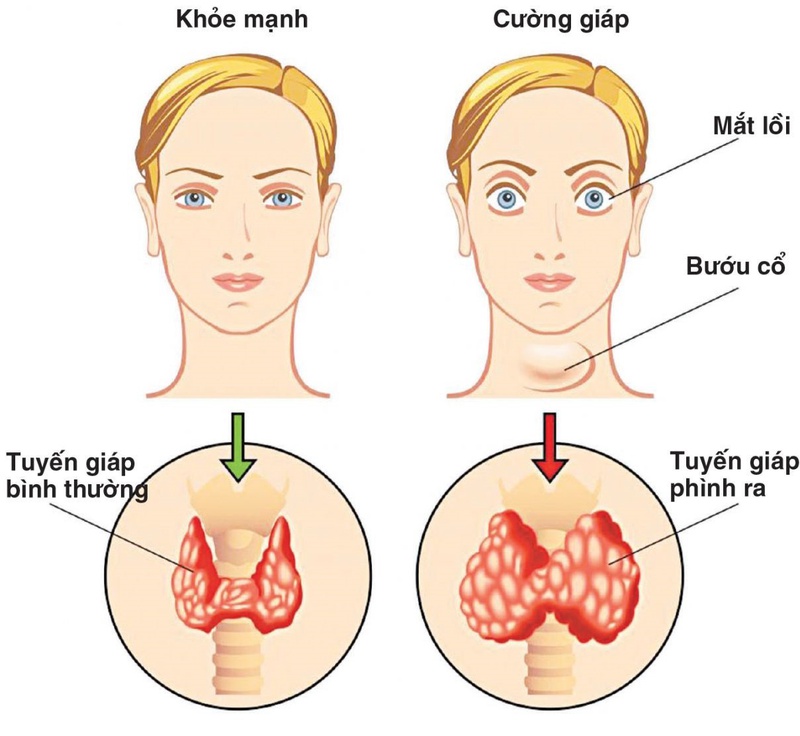 Bệnh cường giáp là gì? Bệnh cường giáp có nguy hiểm không? 1