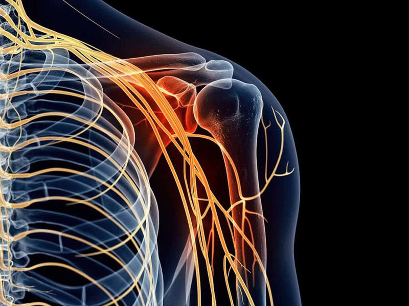 Bệnh đám rối thần kinh cánh tay: Nguyên nhân và cách điều trị 2