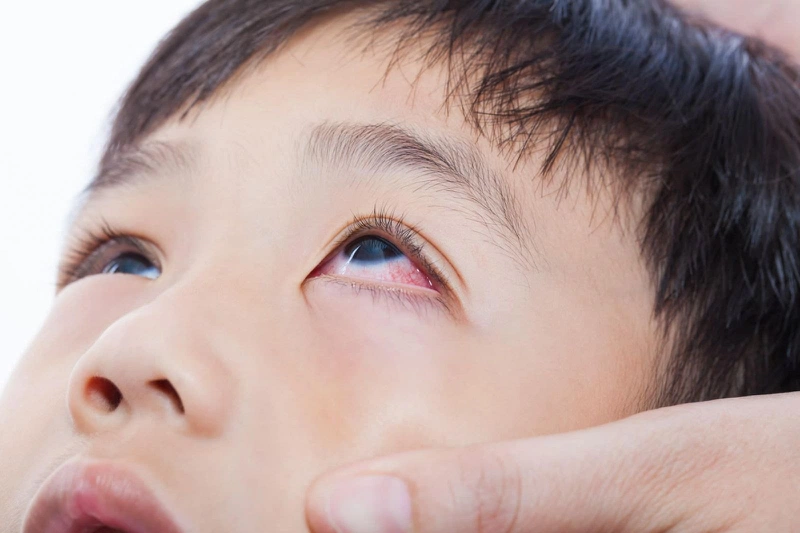 Bệnh đau mắt đỏ 1 bên có lây sang mắt bên kia không?1