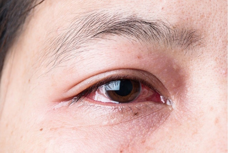 Bệnh đau mắt đỏ và cách phòng chống lây nhiễm mẹ cần biết