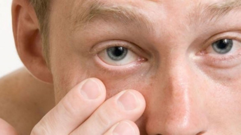 Bệnh đau mắt hột lây qua đường nào? 1