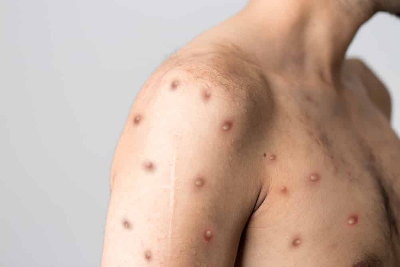 Bệnh đậu mùa khỉ ở Việt Nam và những điều bạn nên biết1