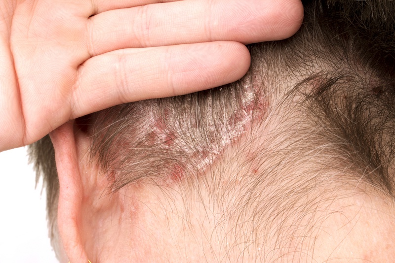 Bệnh dị ứng da đầu căn bệnh gây phiền toái cho nhiều người