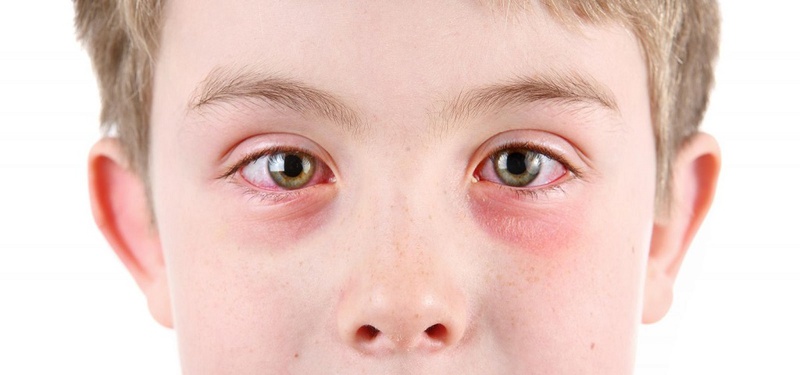 Bệnh dị ứng mắt là gì? Khắc phục như thế nào?