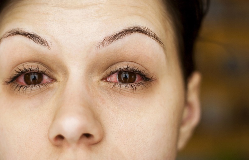 Bệnh dị ứng mắt là gì? Khắc phục như thế nào?