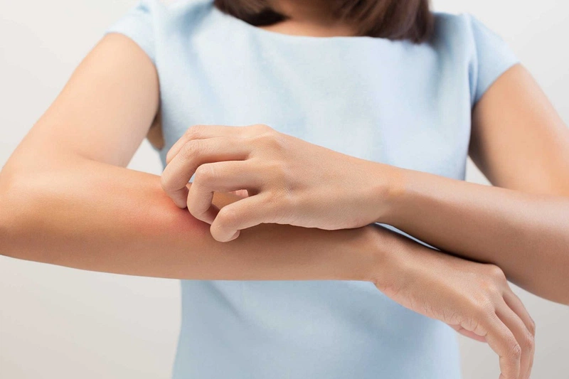 Bị bệnh dị ứng mồ hôi gây ngứa ngáy phải làm sao 1