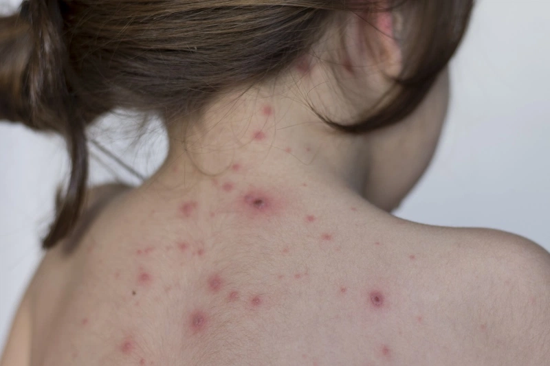 Nguyên nhân và dấu hiệu bệnh dị ứng nhiễm trùng 2