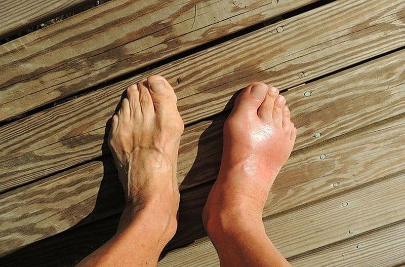 Biến chứng của bệnh gout mà mọi người cần lưu ý 3