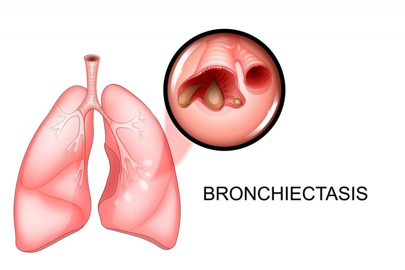 Bệnh giãn phế quản có lây không?1
