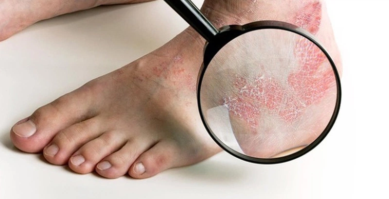 Bệnh lác đồng tiền có lây không? Cách phòng ngừa hiệu quả 3