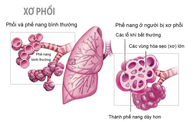 Bệnh lao phổi và 5 di chứng sau khi điều trị lao phổi 3