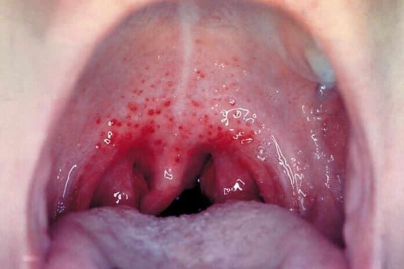 Bệnh lậu có nguy hiểm không? Một số triệu chứng thường gặp 2