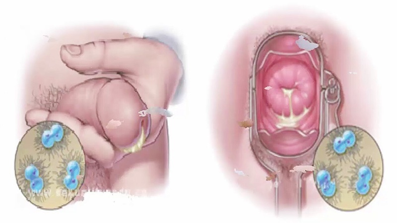 Bệnh lậu lây qua đường nào? Cách phòng tránh hiệu quả nhất 1