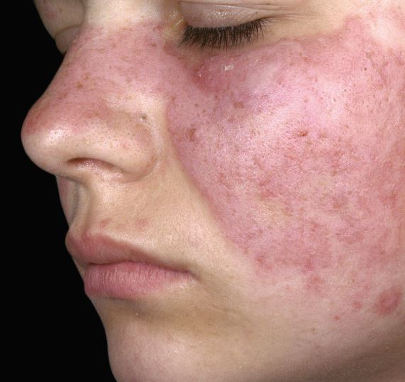 Bệnh lupus ban đỏ có nhổ răng được không? Dấu hiệu nhận biết là gì? 1