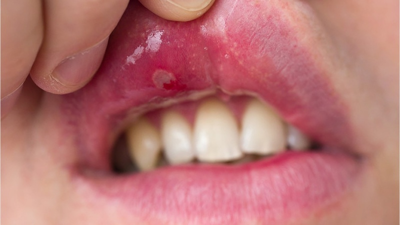 Bệnh lupus ban đỏ có nhổ răng được không? Dấu hiệu nhận biết là gì? 4