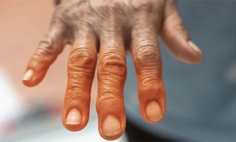 Điều trị lupus ban đỏ rải rác bằng phương pháp thay huyết tương 2