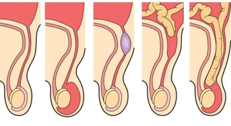 Bệnh lý còn ống phúc tinh mạc ở trẻ em 1