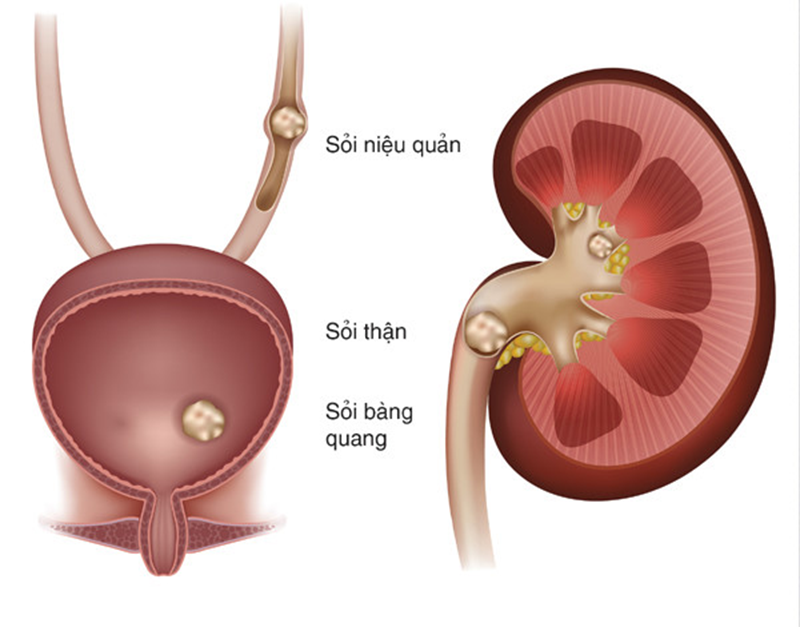 Bệnh lý sỏi tiết niệu và những hệ quả không lường 1