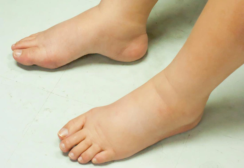Bệnh lý suy thận là gì? Những dấu hiệu suy thận giai đoạn đầu 1