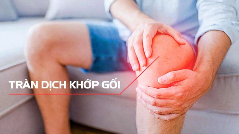Tràn dịch khớp gối là tình trạng khớp gối bị gia tăng một lượng dịch thất thường