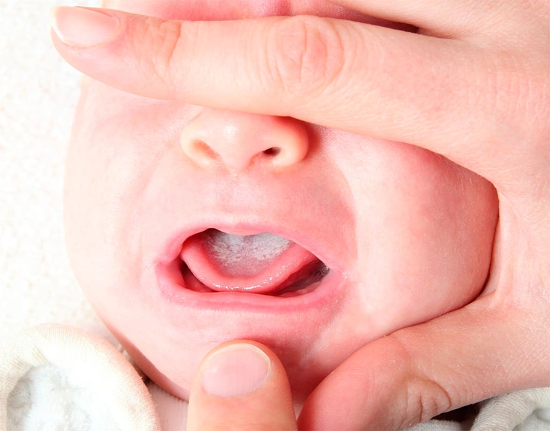 Bệnh nấm miệng ở trẻ dưới 1 tuổi: Nguyên nhân, chẩn đoán, điều trị ...
