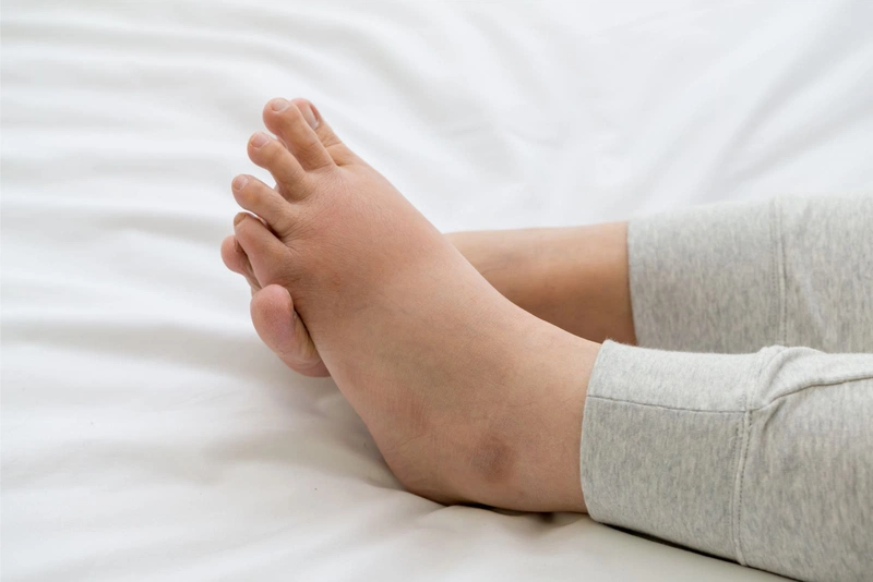 Bệnh nhân ung thư phổi bị phù chân1