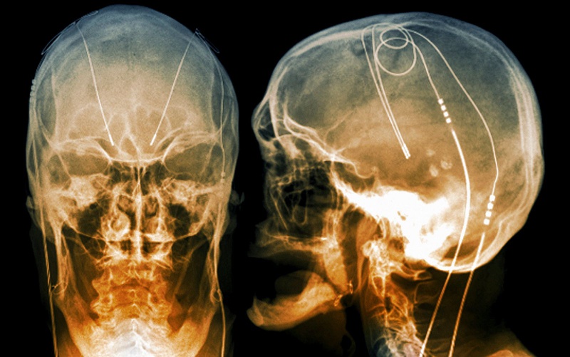 Giải đáp: Bệnh Parkinson có chữa được không? 5