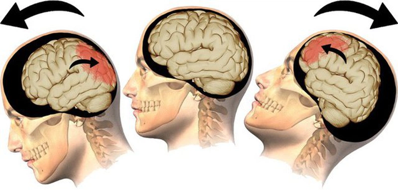 Liệu bệnh parkinson có di truyền không 5