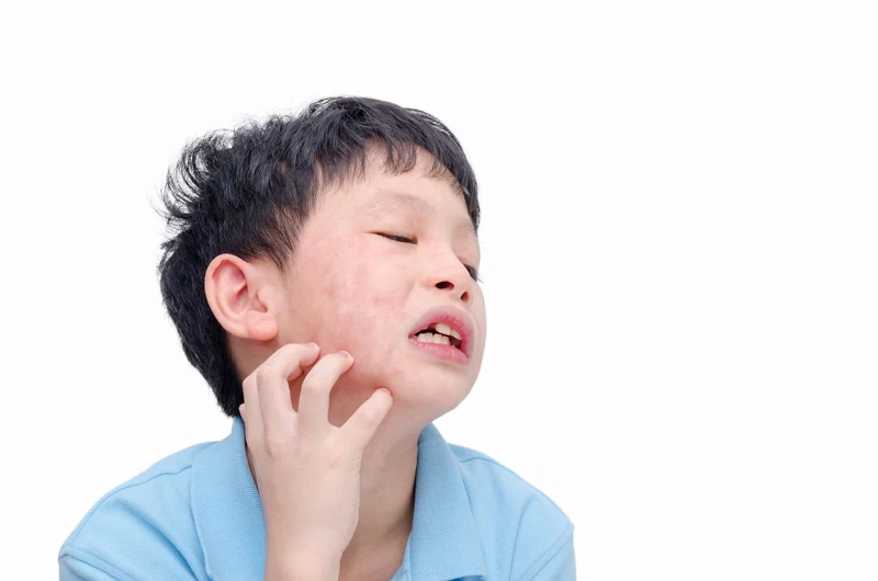 Bệnh quai bị lây qua đường gì?