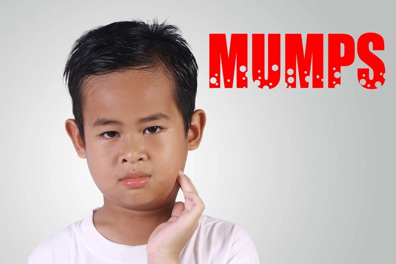 Bệnh quai bị ở trẻ em có phòng ngừa được không? 01