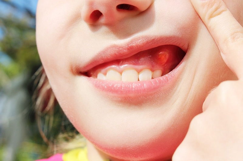 Bệnh răng miệng ở trẻ em: Nguyên nhân và cách điều trị 2