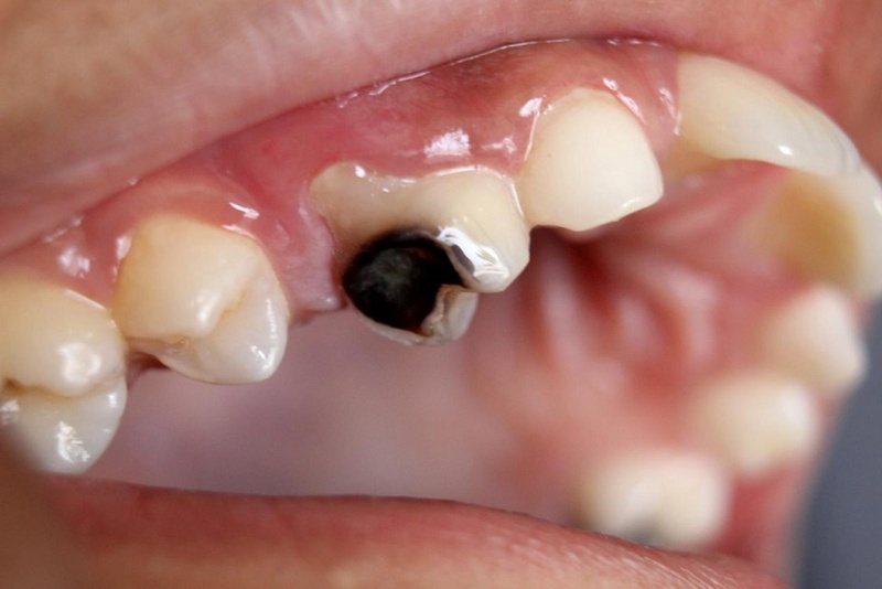 Bệnh răng miệng ở trẻ em: Nguyên nhân và cách điều trị 3