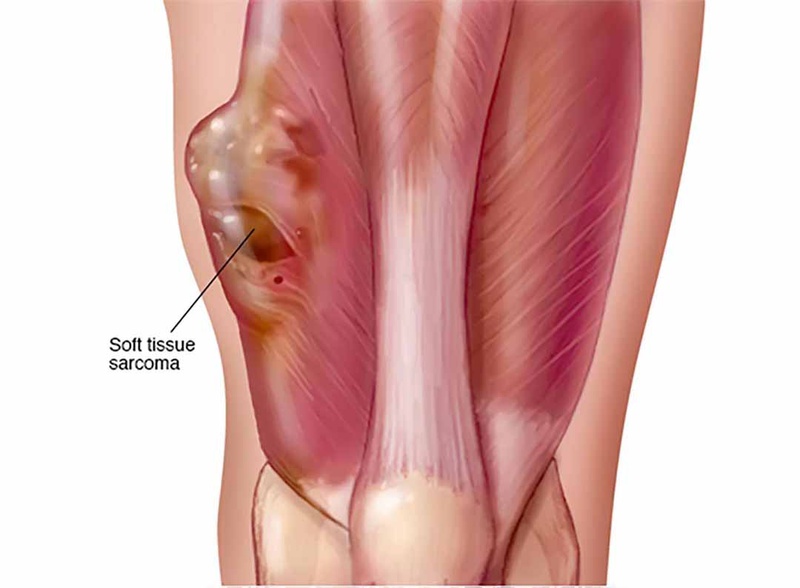 Sarcoma cơ vân ở trẻ em: Giới thiệu