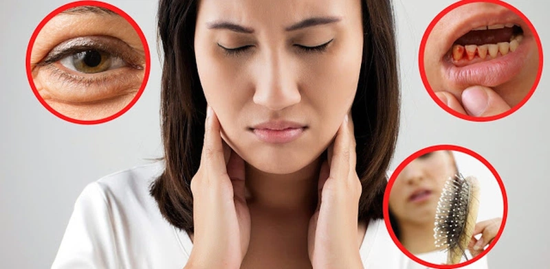 Giải đáp: Người mắc bệnh Scorbut do thiếu hụt Vitamin nào? 1