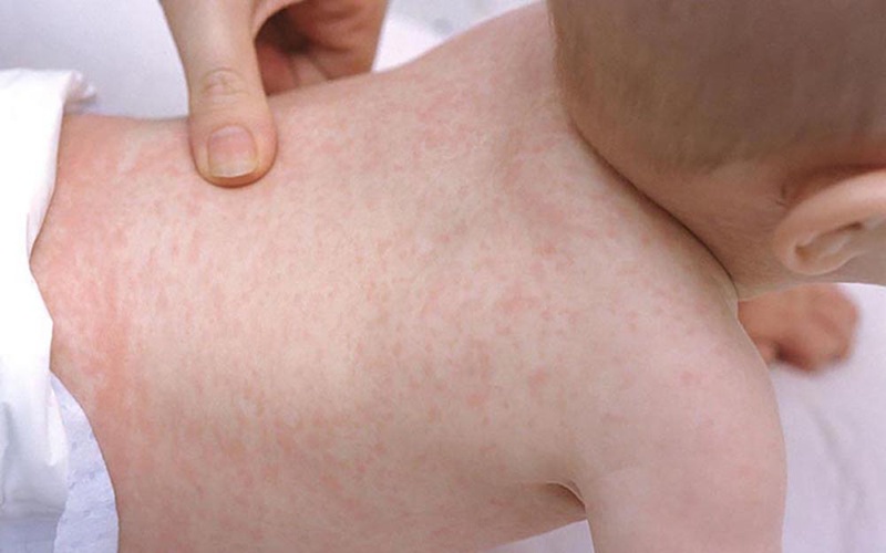 Bệnh sởi có lây không? Cách phòng ngừa sởi hiệu quả nhất 1