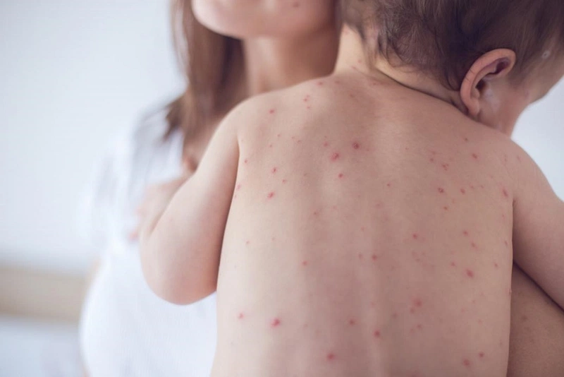Người bị bệnh sởi kiêng gì và cách chăm sóc ngay tại nhà 1