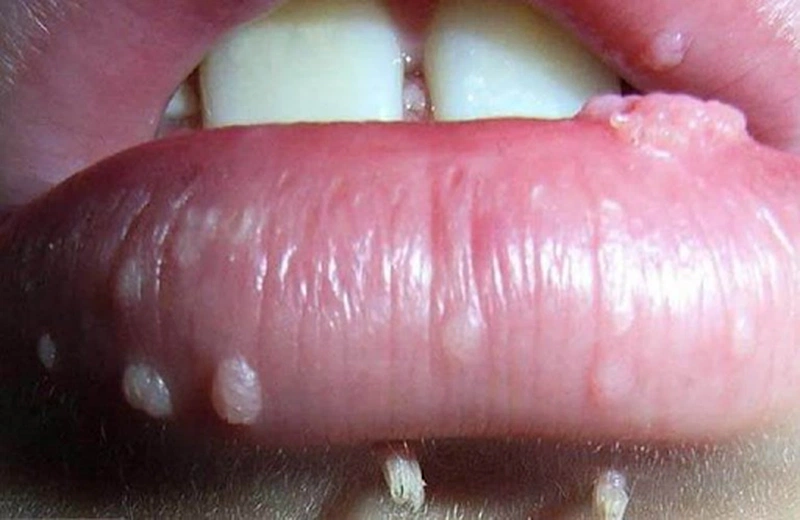 Cách phòng tránh bệnh sùi mào gà ở miệng