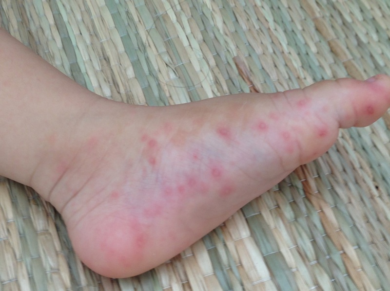 Hỏi và đáp: Bệnh tay chân miệng là gì và dấu hiệu nhận biết 1