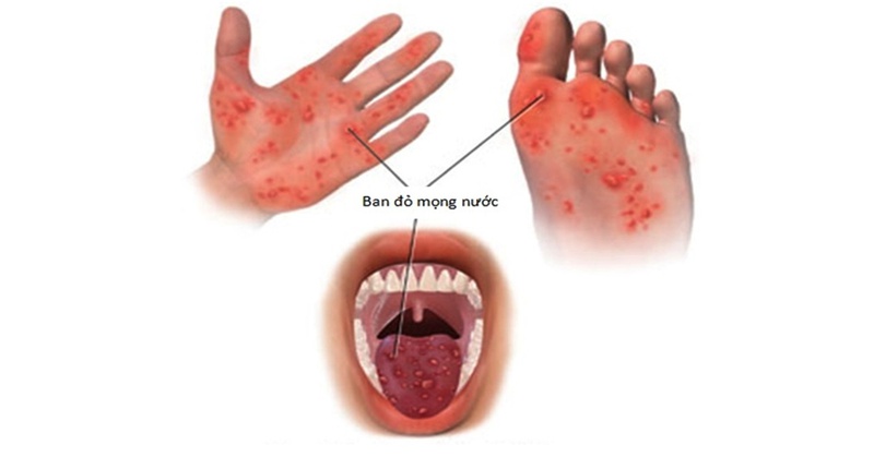 Bệnh tay chân miệng ở trẻ nhỏ: Dấu hiệu nhận biết và cách điều trị 2