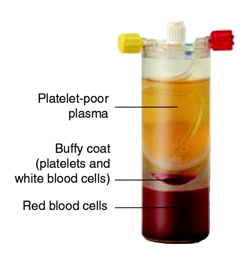 5 cách điều trị bệnh thiếu máu huyết tán phổ biến hiện nay 2