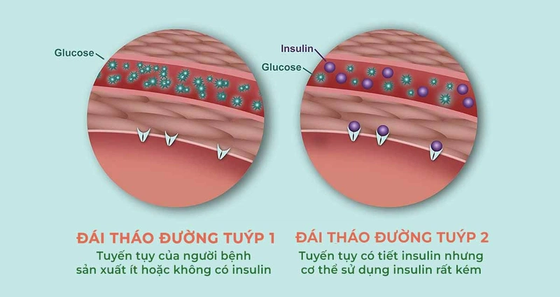 Góc giải đáp: Uống sữa Anlene có bị tiểu đường không? 1